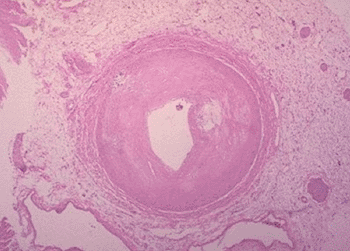 Image: Histology of severe coronary atherosclerosis (Photo courtesy of Medical Educational).